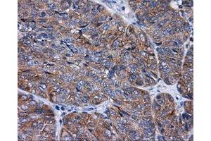 Immunohistochemical staining of paraffin-embedded Adenocarcinoma of colon tissue using anti-RALBP1 mouse monoclonal antibody. (RALBP1 抗体)