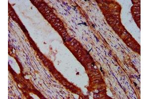 IHC image of ABIN7175679 diluted at 1:500 and staining in paraffin-embedded human colon cancer performed on a Leica BondTM system. (WIPF2 抗体  (AA 18-176))