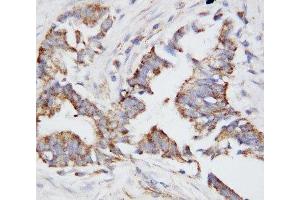 IHC-P: OPN antibody testing of human breast cancer tissue (Osteopontin 抗体  (N-Term))
