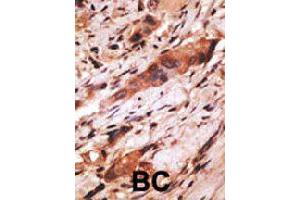 Formalin-fixed and paraffin-embedded human cancer tissue reacted with CD82 polyclonal antibody  , which was peroxidase-conjugated to the secondary antibody, followed by AEC staining. (CD82 抗体  (C-Term))