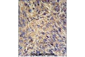 HSP90B1 Antibody (N-term) (ABIN651092 and ABIN2840067) IHC analysis in formalin fixed and paraffin embedded human lung carcinoma followed by peroxidase conjugation of the secondary antibody and DAB staining.