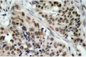 Immunohistochemistry (IHC) analyzes of p-FoxO1 antibody in paraffin-embedded human breast carcinoma tissue. (FOXO1 抗体  (pSer256))