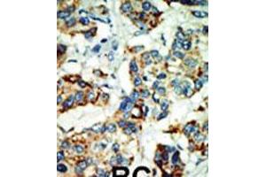 Formalin-fixed and paraffin-embedded human cancer tissue reacted with the primary antibody, which was peroxidase-conjugated to the secondary antibody, followed by AEC staining. (NEK4 抗体  (C-Term))