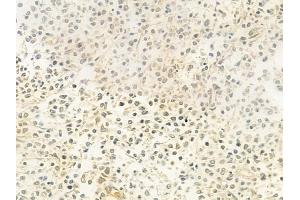 ABIN6263588 and ABIN6279411 at 1/100 staining human Hodgkin lymphoma by IHC-P. (NEIL2 抗体  (Internal Region))