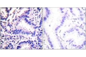 Immunohistochemistry analysis of paraffin-embedded human lung carcinoma tissue, using Synuclein gamma Antibody. (SNCG 抗体  (AA 78-127))