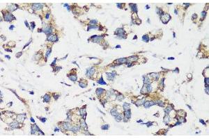 Immunohistochemistry of paraffin-embedded Human gastric cancer using TSC1 Polyclonal Antibody at dilution of 1:200 (40x lens).