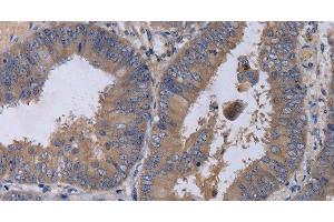 Immunohistochemistry of paraffin-embedded Human colon cancer tissue using MKKS Polyclonal Antibody at dilution 1:50 (MKKS 抗体)