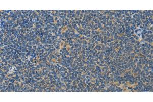 Immunohistochemistry of paraffin-embedded Human lymphoma using ASPA Polyclonal Antibody at dilution of 1:80 (ASPA 抗体)