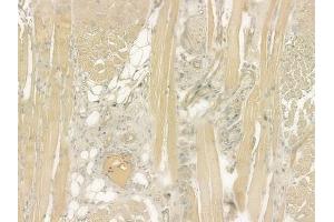 ABIN6260106 and ABIN6276528 at 1/100 staining human tongue carcinoma by IHC-P.