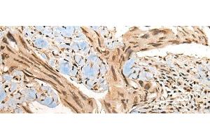 Immunohistochemistry of paraffin-embedded Human breast cancer tissue using CBFB Polyclonal Antibody at dilution of 1:40(x200) (CBFB 抗体)