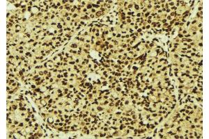 ABIN6277246 at 1/100 staining Human breast cancer tissue by IHC-P. (TNK2 抗体  (C-Term))