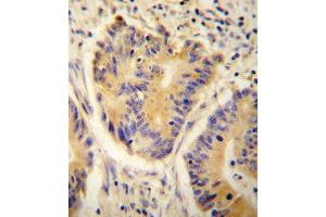 ADH4 Antibody (C-term) (ABIN654087 and ABIN2843975) immunohistochemistry analysis in formalin fixed and paraffin embedded human colon carcinoma followed by peroxidase conjugation of the secondary antibody and DAB staining.
