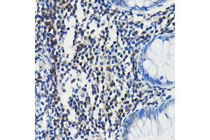 Immunohistochemistry of paraffin-embedded human colon using PIM1 antibody (ABIN7269375) at dilution of 1:100 (40x lens). (PIM1 抗体)