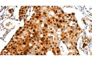 Immunohistochemistry of paraffin-embedded Human breast cancer using Proliferating Cell Nuclear Antigen Polyclonal Antibody at dilution of 1:44 (PCNA 抗体)