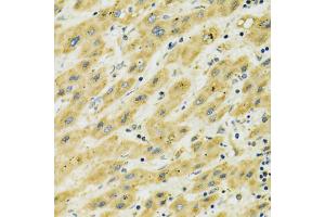 Immunohistochemistry of paraffin-embedded human liver cancer using HSPA9 antibody (ABIN5970207) at dilution of 1/100 (40x lens). (HSPA9 抗体)