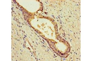 Immunohistochemistry of paraffin-embedded human prostate cancer using ABIN7145605 at dilution of 1:100 (MUTED 抗体  (AA 2-187))