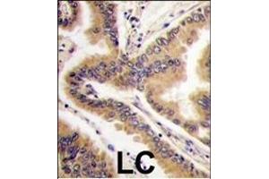 Formalin-fixed and paraffin-embedded human lung carcinoma tissue reacted with P38 delta antibody (C-term), which was peroxidase-conjugated to the secondary antibody, followed by DAB staining. (MAPK13 抗体  (C-Term))