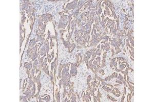 IHC analysis of Cytokeratin 19 using anti-Cytokeratin 19 antibody (ABIN3043288). (Cytokeratin 19 抗体  (C-Term))