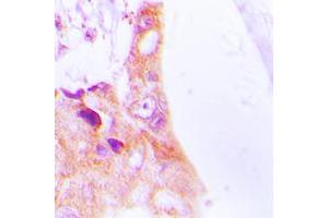 Immunohistochemical analysis of Cytokeratin 8 staining in human lung cancer formalin fixed paraffin embedded tissue section. (KRT8 抗体  (Center))
