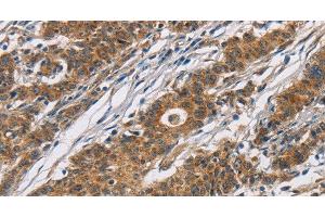 Immunohistochemistry of paraffin-embedded Human gasrtic cancer tissue using CYP21A2 Polyclonal Antibody at dilution 1:60 (CYP21A2 抗体)
