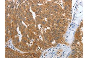 The image on the left is immunohistochemistry of paraffin-embedded Human ovarian cancer tissue using ABIN7191700(NPY1R Antibody) at dilution 1/25, on the right is treated with synthetic peptide. (NPY1R 抗体)