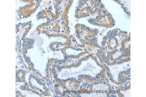 Immunohistochemistry of Human colon cancer using ASCC1 Polyclonal Antibody at dilution of 1:50