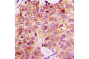Immunohistochemical analysis of GAK staining in human breast cancer formalin fixed paraffin embedded tissue section. (GAK 抗体  (N-Term))