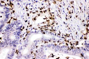 Cathepsin G was detected in paraffin-embedded sections of human intestinal cancer tissues using rabbit anti- Cathepsin G Antigen Affinity purified polyclonal antibody (Catalog # ) at 1 ? (Cathepsin G 抗体  (AA 25-252))