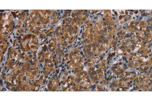 Immunohistochemistry of paraffin-embedded Human thyroid cancer tissue using LLGL1 Polyclonal Antibody at dilution 1:40 (LLGL1 抗体)
