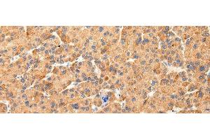 Immunohistochemistry of paraffin-embedded Human liver cancer tissue using AQP7 Polyclonal Antibody at dilution 1:40 (Aquaporin 7 抗体)