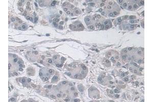 Detection of Ub in Human Pancreatic cancer Tissue using Polyclonal Antibody to Ubiquitin (Ub)