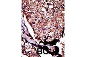 Formalin-fixed and paraffin-embedded human cancer tissue reacted with the primary antibody, which was peroxidase-conjugated to the secondary antibody, followed by DAB staining. (DGKB 抗体  (C-Term))