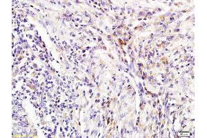 Formalin-fixed and paraffin embedded human colon carcinoma labeled with Rabbit Anti NGAL/Lipocalin 2 Polyclonal Antibody, Unconjugated (ABIN685627) at 1:200 followed by conjugation to the secondary antibody and DAB staining (Lipocalin 2 抗体  (AA 101-198))