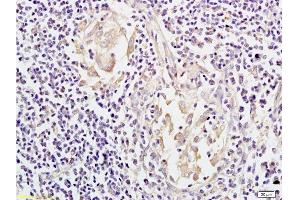 Formalin-fixed and paraffin embedded: human colon carcinoma labeled with Anti-Mesothelin Polyclonal Antibody, Unconjugated  at 1:200, followed by conjugation to the secondary antibody and DAB staining (Mesothelin 抗体  (AA 101-200))