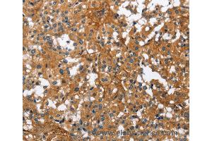 Immunohistochemistry of Human liver cancer using BGN Polyclonal Antibody at dilution of 1:50