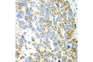 Immunohistochemistry of paraffin-embedded human esophageal cancer using CHIA antibody. (CHIA 抗体)