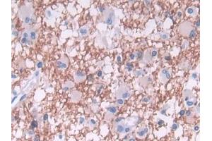 Detection of TDH in Human Glioma Tissue using Polyclonal Antibody to L-Threonine Dehydrogenase (TDH) (Tdh 抗体  (AA 1-229))