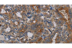Immunohistochemistry of paraffin-embedded Human thyroid cancer tissue using PER2 Polyclonal Antibody at dilution 1:50 (PER2 抗体)