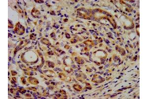 IHC image of ABIN7157616 diluted at 1:400 and staining in paraffin-embedded human pancreatic cancer performed on a Leica BondTM system. (KIF2B 抗体  (AA 1607-1731))