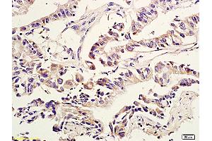 Formalin-fixed and paraffin embedded human colon cancer labeled with Anti Amphiregulin Polyclonal Antibody, Unconjugated (ABIN704996) at 1:600 followed by conjugation to the secondary antibody and DAB staining (Amphiregulin 抗体  (AA 185-252))