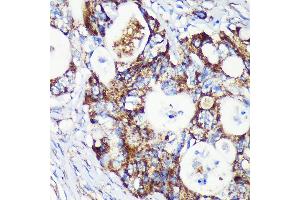 Immunohistochemistry of paraffin-embedded Human colon carcinoma using T Rabbit pAb (ABIN7266436) at dilution of 1:100 (40x lens). (TACO1 抗体  (AA 1-297))