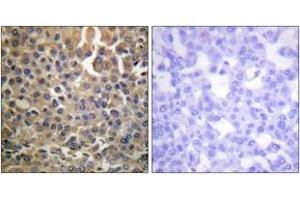 Immunohistochemistry analysis of paraffin-embedded human breast carcinoma, using HER4 (Phospho-Tyr1284) Antibody. (ERBB4 抗体  (pTyr1284))