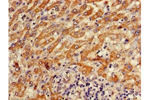 Immunohistochemistry of paraffin-embedded human liver cancer using ABIN7144848 at dilution of 1:100 (ATP5F1D 抗体  (AA 23-168))