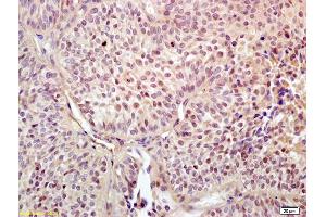 Formalin-fixed and paraffin embedded human endometrial carcinoma labeled with Anti-UBF1/RNA polymerase I Polyclonal Antibody, Unconjugated  at 1:200 followed by conjugation to the secondary antibody and DAB staining
