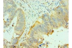 Immunohistochemistry of paraffin-embedded human colon cancer using ABIN7147105 at dilution of 1:100 (CNOT8 抗体  (AA 1-292))