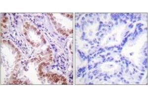 Immunohistochemistry analysis of paraffin-embedded human lung carcinoma tissue, using Histone H3 (Ab-9) Antibody. (Histone 3 抗体  (AA 1-50))