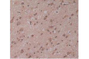 IHC-P analysis of Human Glioma Tissue, with DAB staining. (ENPP2 抗体  (AA 637-905))