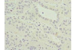 Immunohistochemistry of paraffin-embedded human liver cancer using ABIN7165022 at dilution of 1:100 (AF9 抗体  (AA 1-150))