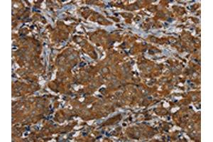 The image on the left is immunohistochemistry of paraffin-embedded Human breast cancer tissue using ABIN7191878(PIK3CD Antibody) at dilution 1/20, on the right is treated with synthetic peptide. (PIK3CD 抗体)