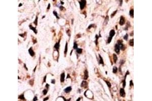 IHC analysis of FFPE breast carcinoma stained with phospho-SMAD4 antibody.